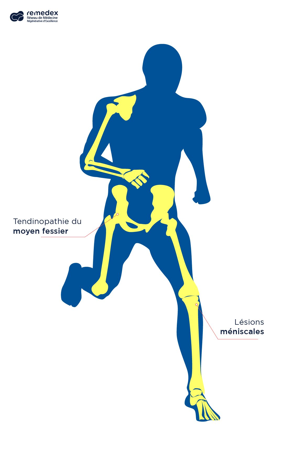 Fiche pathologie du logiciel Remedex — tendinopathie du moyen fessier